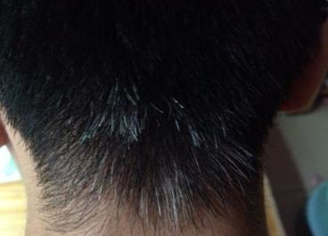 一招解决白发再也不用去染发,治疗白发的最佳方法染发