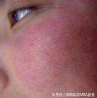 激素皮炎的修复原理,激素依赖性皮炎如何修复受损肌肤