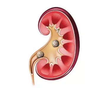 腰疼是因为肾结石着凉后就疼,腰疼和肾结石有关系吗
