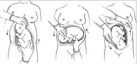 孕妇胎位不正医生使出乾坤大挪移,孕妇胎位不正医生手动转正胎位