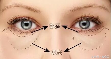 眼袋一笑就成卧蚕了是啥类型眼袋,什么样的眼袋是真正的眼袋