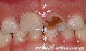 乳前牙透明冠修复大概要多久,乳前牙透明冠操作流程