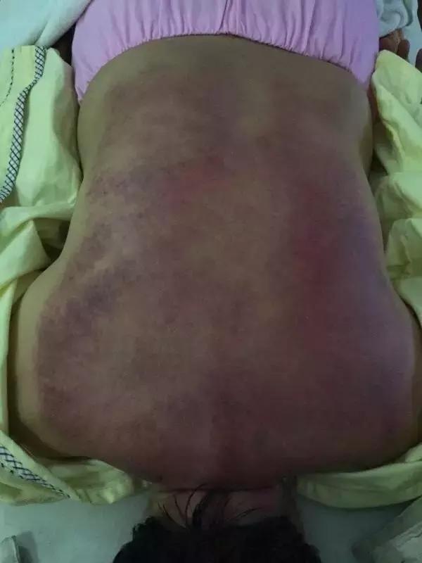 四高怎么调理才能彻底根除,四高最严重是什么表现