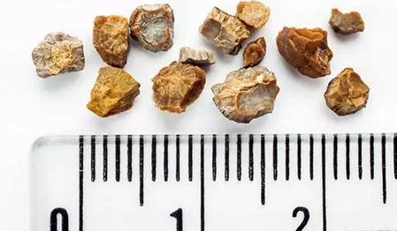 腰疼是因为肾结石着凉后就疼,腰疼和肾结石有关系吗