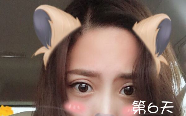 鼓起勇气做了个双眼皮,鼓起勇气做了医美