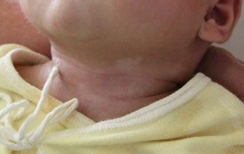 治疗白癜风光疗有副作用吗,儿童白癜风308激光一周几次最好