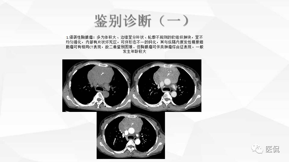 精原细胞瘤ct影像,精原细胞瘤影像特征