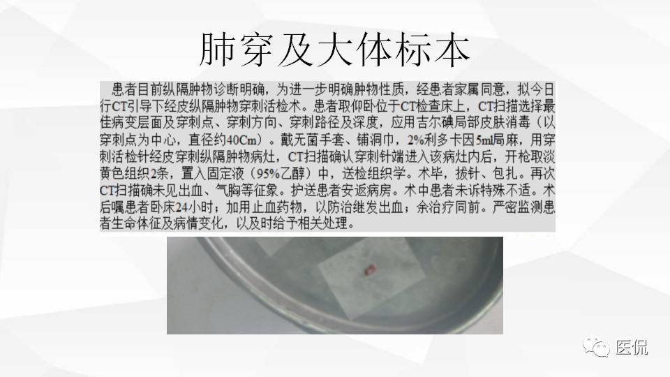 精原细胞瘤ct影像,精原细胞瘤影像特征