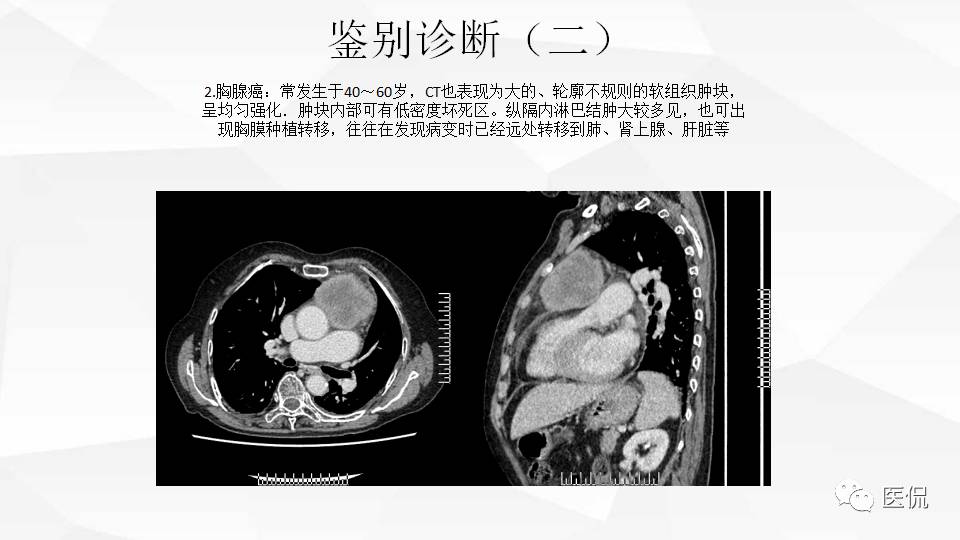 精原细胞瘤ct影像,精原细胞瘤影像特征