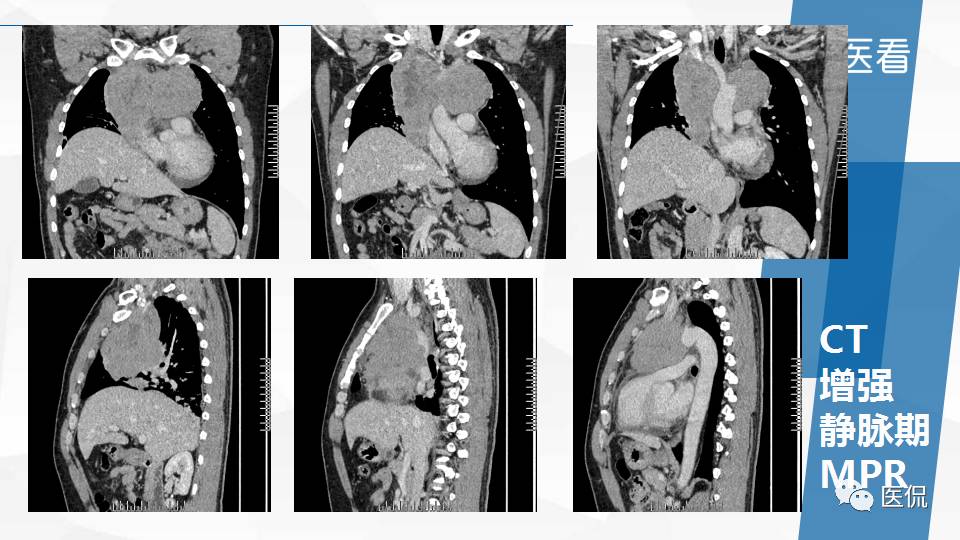 精原细胞瘤ct影像,精原细胞瘤影像特征