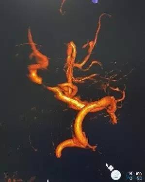 椎动脉狭窄支架植入术需要多少钱,颅内动脉狭窄支架手术后哪些症状