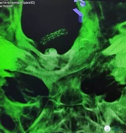 椎动脉狭窄支架植入术需要多少钱,颅内动脉狭窄支架手术后哪些症状