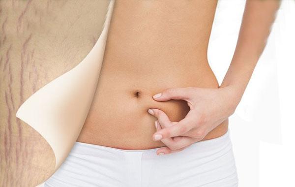 祛妊娠纹的凝胶产后多久开始抹,产后祛除妊娠纹有哪些方法