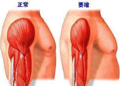 进行性肌营养不良症筛查,进行性肌营养不良问诊