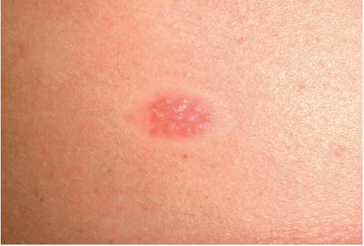 银屑病关节炎和银屑病区别,银屑病关节炎跟银屑病一样吗