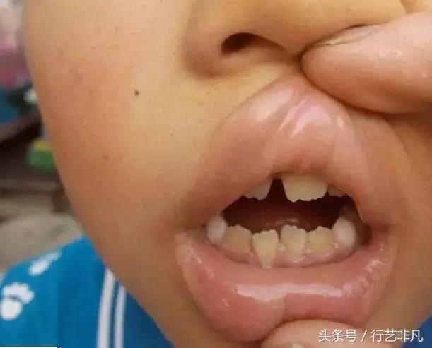 牙黄刷牙时加什么能变白,牙黄刷牙美白