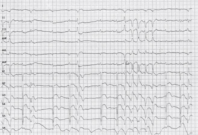 冠状动脉粥样硬化性心脏病知识点,冠状动脉粥样硬化性心脏病怎样治
