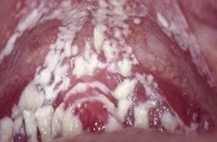 白带异常是宫颈癌吗,白带异常是宫颈炎吗