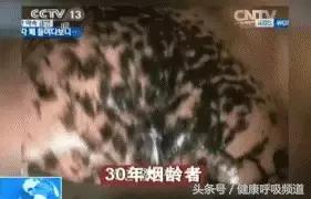 慢阻肺肺气肿的最佳治疗方法,肺气肿买什么样的呼吸锻炼仪好