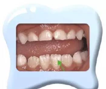 小孩子换的牙齿为什么越来越丑,小孩换的新牙又掉了怎么办