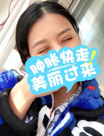 割双眼皮一个月效果,40岁割双眼皮效果好不