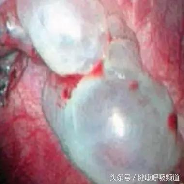 至简清肺仪对肺气肿人有效吗,肺大泡或肺气肿能不能使用清肺仪