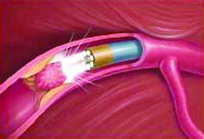 血管修复术有没有后遗症,血管疏通手术成功率