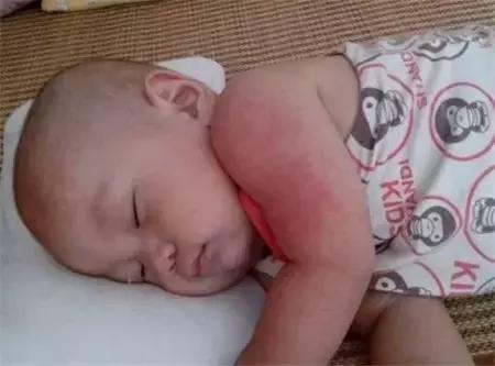 预防痱子最有效的方法成年人,夏天太热怎样预防孩子长痱子