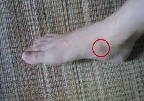 打完球足弓痛怎么缓解,打完球内侧足弓疼痛是什么原因