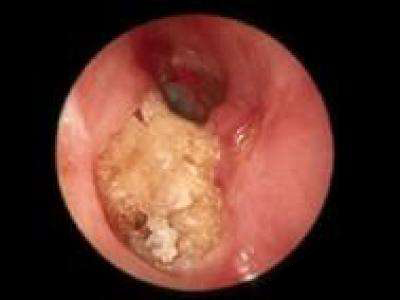 耳科常见疾病及治疗措施大全（友谊医院版）