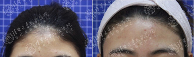 激光脱毛后的真实感受,激光脱毛一年后的真实感受