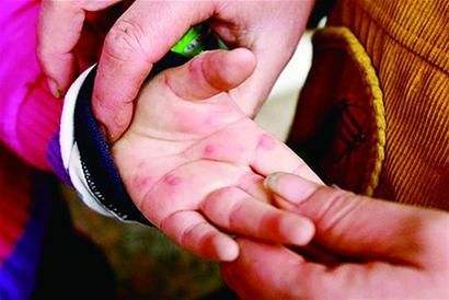 嘴巴上的红点点是什么,嘴里都是红色的点点