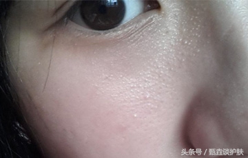 眼睛长脂肪粒怎么去除最简单方法,眼睛长脂肪粒怎么去除小窍门