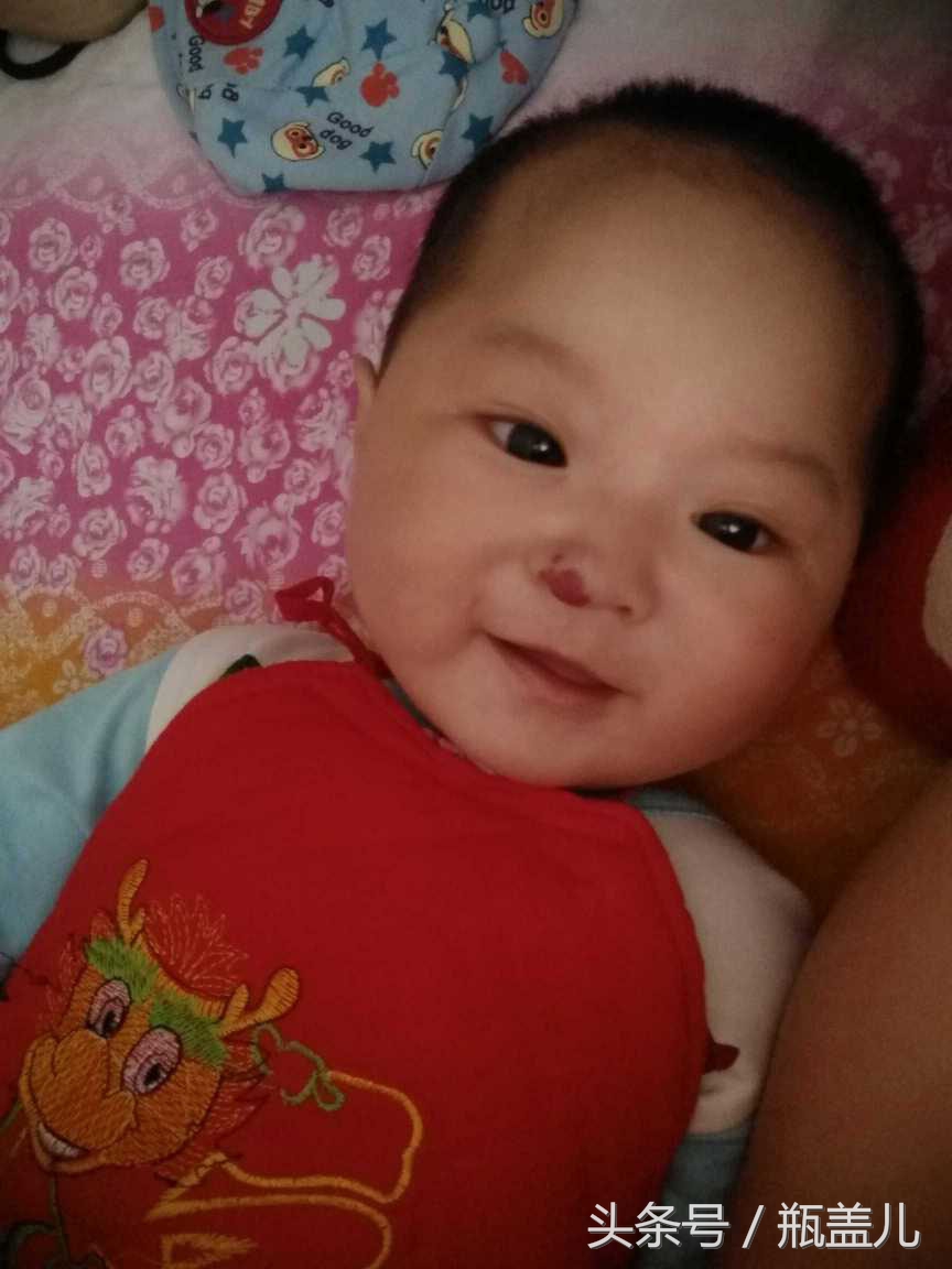 宝宝鼻子上的血管瘤怎么办,宝宝鼻子上长血管瘤怎么治