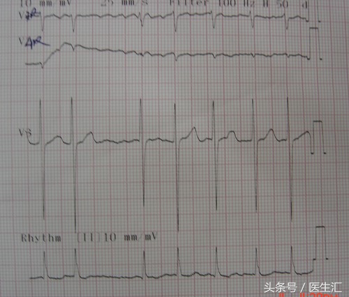 脑溶栓治疗一般多少钱,溶栓治疗需要多少费用