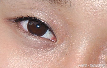 眼睛长脂肪粒怎么去除最简单方法,眼睛长脂肪粒怎么去除小窍门