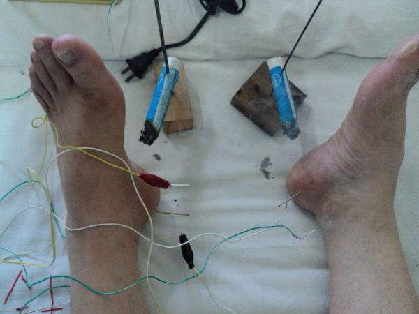 足跟痛为什么反复发作难治愈,足跟痛反复发作怎么办