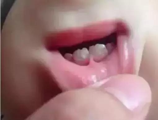 乳牙到底要不要根管治疗,儿童乳牙是全部要换的吗