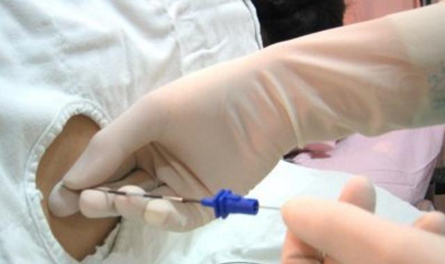 剖腹产麻药针,剖腹产脊椎打麻药的地方有个疙瘩