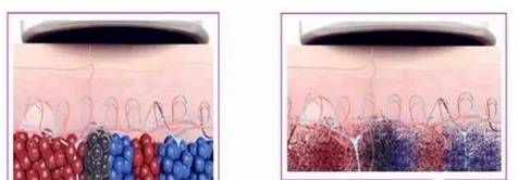 皮秒祛斑后遗症,皮秒激光祛斑仪