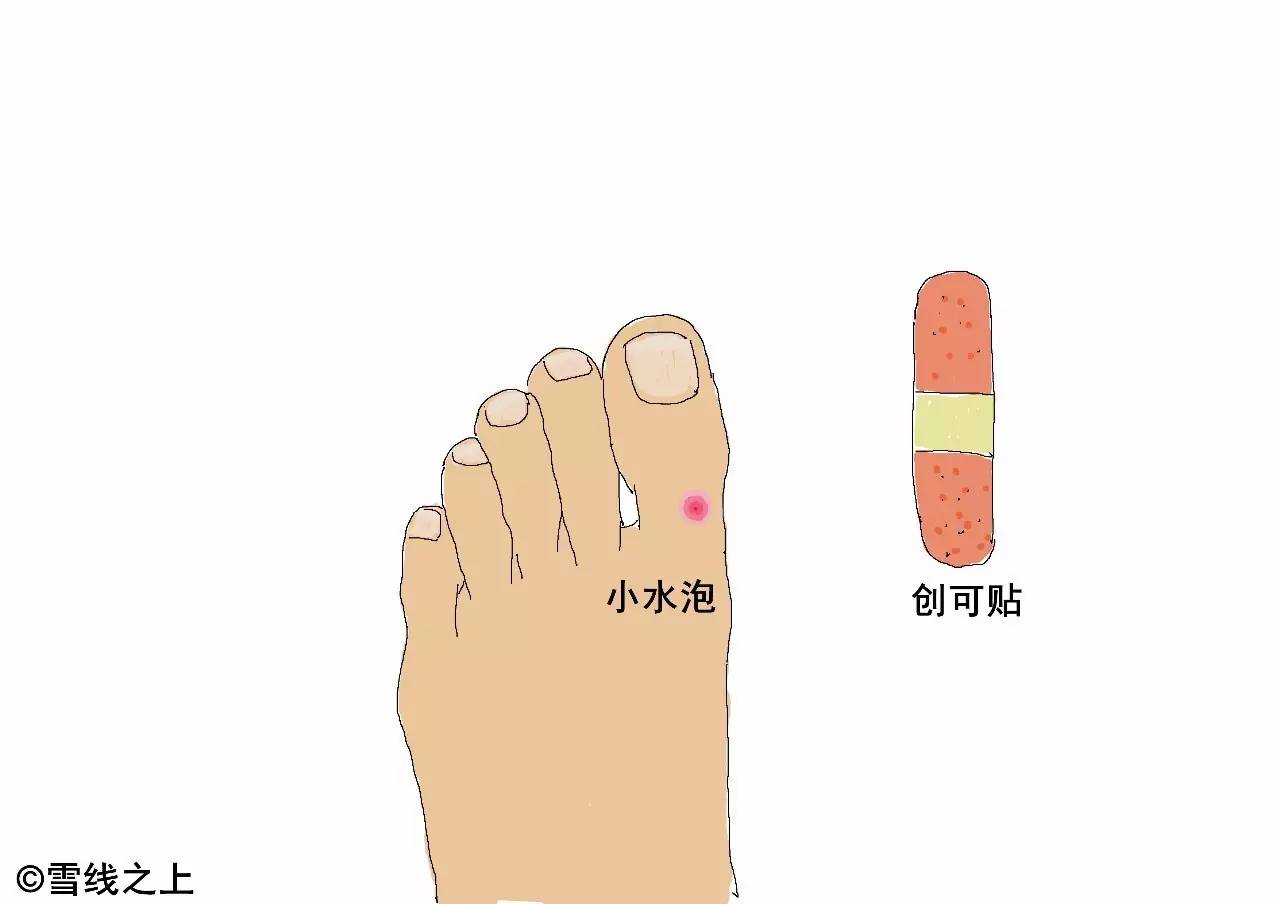 徒步走线时，如何防治水泡？