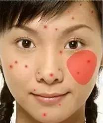 脸的侧面为什么长一些小痘痘,为什么额头上长了好多痘痘