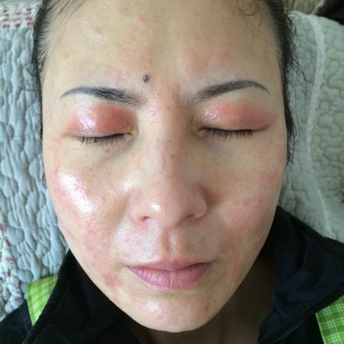 美版超声刀的副作用,做超声刀后有何副作用