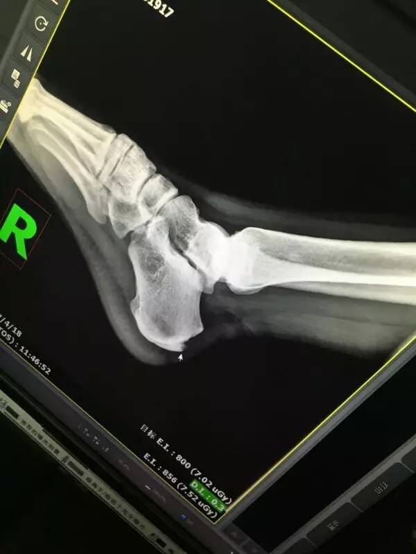 康复训练啥时候可以负重,康复训练答疑直播