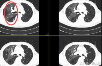 两年了老是咳嗽怎么回事,老人稍微活动气急气喘怎么办