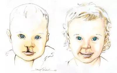 四维彩超查出胎儿不正常的指标,四维彩超看不出唐氏儿