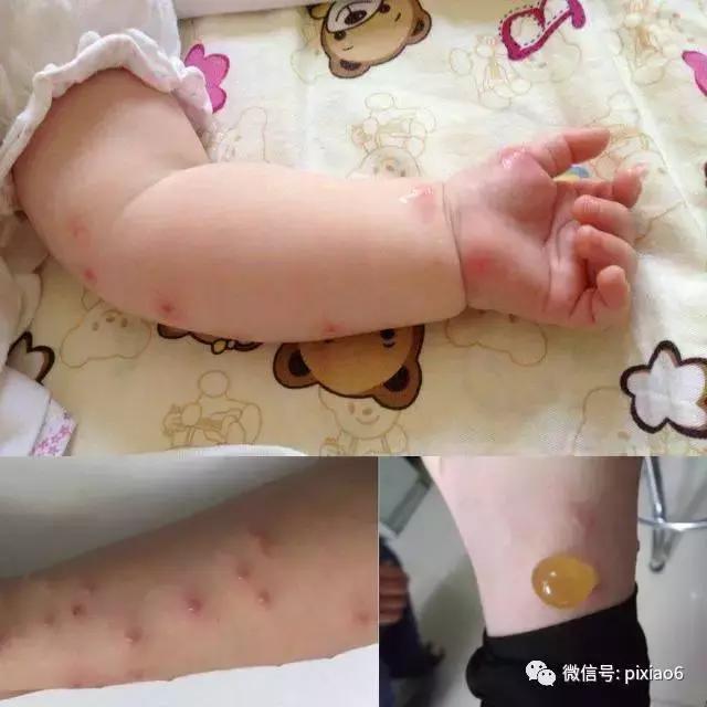 是谁?一口下去浑身水疱,奇痒难忍还不敢挠!一瓶好物要常备!