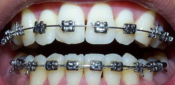 拔牙矫正过程中有龋齿,拔牙矫正有什么后遗症吗