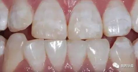 冷光美白牙齿靠谱吗,牙齿美白全过程视频