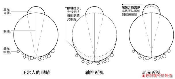近视手术好处和坏处,做近视手术有坏处么